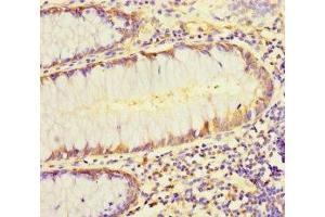 Immunohistochemistry of paraffin-embedded human colon cancer using ABIN7158401 at dilution of 1:100 (L1TD1 Antikörper  (AA 665-865))