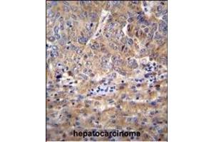 DEF Antibody (N-term) (ABIN655755 and ABIN2845199) immunohistochemistry analysis in formalin fixed and paraffin embedded human hepatocarcinoma followed by peroxidase conjugation of the secondary antibody and DAB staining. (ZC3H18 Antikörper  (N-Term))