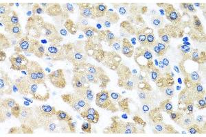 Immunohistochemistry of paraffin-embedded Human liver damage using SNAP29 Polyclonal Antibody at dilution of 1:100 (40x lens). (SNAP29 Antikörper)