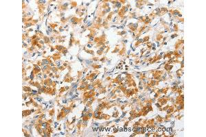 Immunohistochemistry of Human liver cancer using ANAPC2 Polyclonal Antibody at dilution of 1:30