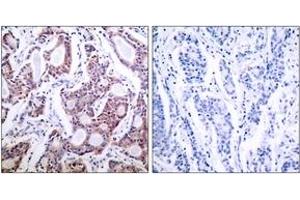 Immunohistochemistry analysis of paraffin-embedded human breast carcinoma tissue, using NF-kappaB p100/p52 (Ab-869) Antibody. (NFKB2 Antikörper  (AA 836-885))