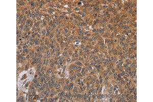 Immunohistochemistry of Human lung cancer using GH2 Polyclonal Antibody at dilution of 1:40 (Growth Hormone 2 Antikörper)