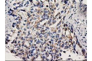 Immunohistochemical staining of paraffin-embedded Carcinoma of Human lung tissue using anti-NDEL1 mouse monoclonal antibody. (NDEL1 Antikörper)