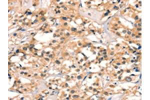 The image on the left is immunohistochemistry of paraffin-embedded Human thyroid cancer tissue using ABIN7129096(CUEDC2 Antibody) at dilution 1/30, on the right is treated with fusion protein. (CUEDC2 Antikörper)