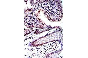 Immunohistochemical analysis of paraffin-embedded human intima cancer tissue (A) and colon tissue (B) using PSMB8 monoclonal antobody, clone 1A5  with DAB staining.