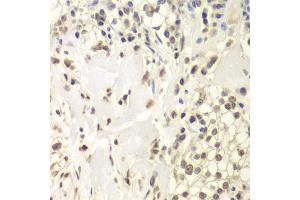 Immunohistochemistry of paraffin-embedded human kidney cancer using USP7 antibody (ABIN6293331) at dilution of 1:200 (40x lens). (USP7 Antikörper)