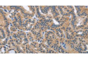 Immunohistochemistry of paraffin-embedded Human thyroid cancer using HSD3B1 Polyclonal Antibody at dilution of 1:40 (HSD3B1 Antikörper)