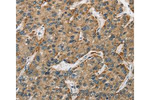 Immunohistochemistry of Human liver cancer using CTSE Polyclonal Antibody at dilution of 1:50
