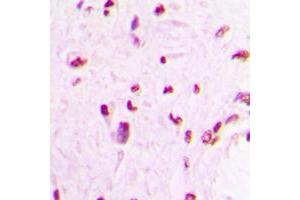 Immunohistochemical analysis of MEF2C staining in human lung cancer formalin fixed paraffin embedded tissue section. (MEF2C Antikörper  (C-Term))