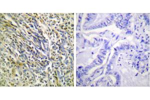 Cl-Peptide - +Immunohistochemical analysis of paraffin-embedded human lung carcinoma tissue using Aggrecan (Cleaved-Asp369) antibody (#L0101). (Aggrecan Antikörper  (Cleaved-Asp369))