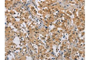 The image on the left is immunohistochemistry of paraffin-embedded Human thyroid cancer tissue using ABIN7129183(DDX43 Antibody) at dilution 1/50, on the right is treated with fusion protein. (DDX43 Antikörper)
