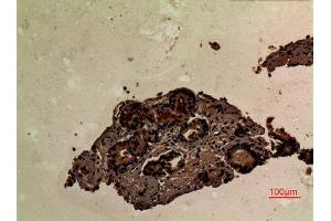 Immunohistochemistry (IHC) analysis of paraffin-embedded Human Prostate Cancer, antibody was diluted at 1:100.