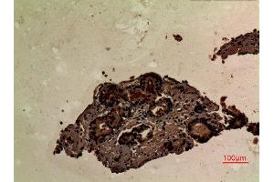 Immunohistochemistry (IHC) analysis of paraffin-embedded Human Prostate Cancer, antibody was diluted at 1:100. (LCP2 Antikörper  (Internal Region))