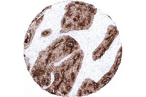 Colorectal adenocarcinoma showing strong CEA immunostaining in tumor cells (Rekombinanter CEA Antikörper)