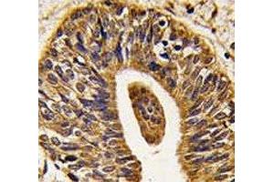IHC analysis of FFPE human prostate carcinoma tissue stained with anti-HER2 antibody (ErbB2/Her2 Antikörper  (AA 1227-1255))