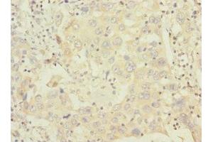 Immunohistochemistry of paraffin-embedded human liver cancer using ABIN7155913 at dilution of 1:100 (HCFC1R1 Antikörper  (AA 1-119))