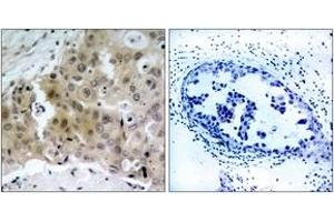 Immunohistochemistry analysis of paraffin-embedded human breast carcinoma, using VEGFR2 (Phospho-Tyr1175) Antibody. (VEGFR2/CD309 Antikörper  (pTyr1175))