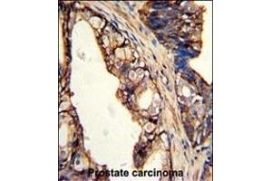 Formalin-fixed and paraffin-embedded human prostate carcinoma with TGM4 Antibody (Center), which was peroxidase-conjugated to the secondary antibody, followed by DAB staining. (TGM4 Antikörper  (AA 135-164))