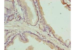 Immunohistochemistry of paraffin-embedded human prostate cancer using ABIN7174755 at dilution of 1:100 (C17orf64 Antikörper  (AA 111-236))