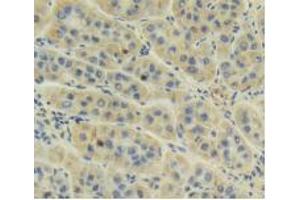 IHC-P analysis of Human Liver Cancer Tissue, with DAB staining. (AMH Antikörper  (AA 453-560))