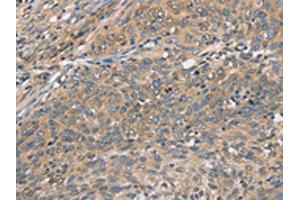 The image on the left is immunohistochemistry of paraffin-embedded Human cervical cancer tissue using ABIN7129065(CST2 Antibody) at dilution 1/50, on the right is treated with fusion protein. (CST2 Antikörper)
