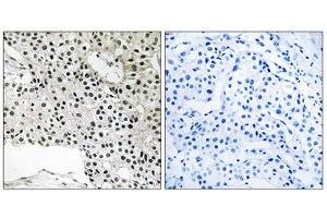 Immunohistochemistry analysis of paraffin-embedded human breast carcinoma tissue using TCEAL4 antibody. (TCEAL4 Antikörper  (C-Term))
