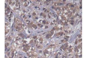 DAB staining on IHC-P; Samples: Human Breast cancer Tissue (UQCRB Antikörper  (AA 2-111))