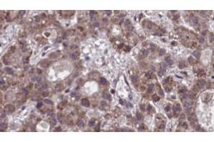 ABIN6273890 at 1/100 staining Human liver cancer tissue by IHC-P.