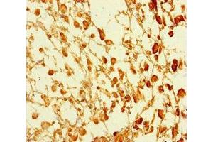 Immunohistochemistry of paraffin-embedded human melanoma using ABIN7172553 at dilution of 1:100 (GATA6 Antikörper  (AA 496-595))