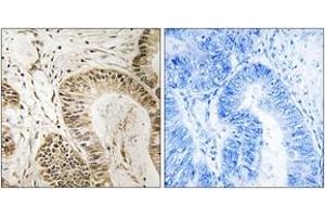 Immunohistochemistry analysis of paraffin-embedded human colon carcinoma tissue, using RGS1 Antibody. (RGS1 Antikörper  (AA 118-167))