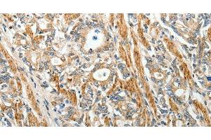 Immunohistochemistry of paraffin-embedded Human gastric cancer using E-Selectin Polyclonal Antibody at dilution of 1:40 (Selectin E/CD62e Antikörper)