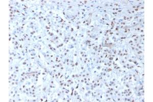 Formalin-fixed, paraffin-embedded human Mesothelioma stained with Wilm's Tumor Mouse Recombinant Monoclonal Antibody (rWT1/857).