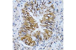 Immunohistochemistry of paraffin-embedded human lung cancer using IMPA1 antibody.
