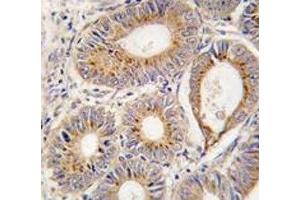 IHC analysis of FFPE human colon carcinoma tissue stained with FGF1 antibody