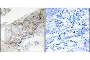Immunohistochemistry analysis of paraffin-embedded human breast carcinoma tissue, using COX5B Antibody. (COX5B Antikörper  (AA 11-60))