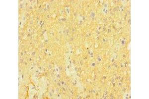 Immunohistochemistry of paraffin-embedded human glioma using ABIN7146992 at dilution of 1:100 (CTNND2 Antikörper  (AA 4-308))