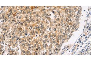 Immunohistochemistry of paraffin-embedded Human lung cancer using JNK2 Polyclonal Antibody at dilution of 1:30 (JNK2 Antikörper)