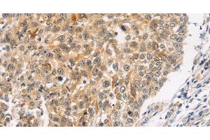 Immunohistochemistry of paraffin-embedded Human lung cancer using JNK2 Polyclonal Antibody at dilution of 1:30 (JNK2 Antikörper)
