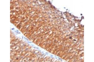 IHC testing of FFPE human bladder carcinoma with Mitochondrial antibody (GFM1 Antikörper)