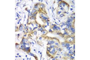 Immunohistochemistry of paraffin-embedded human liver cancer using RPL9 antibody. (RPL9 Antikörper)
