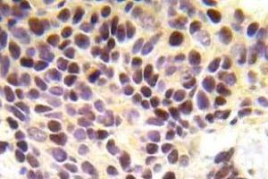 Immunohistochemistry (IHC) analyzes of BRCA1 pAb in paraffin-embedded human breast carcinoma tissue. (BRCA1 Antikörper)