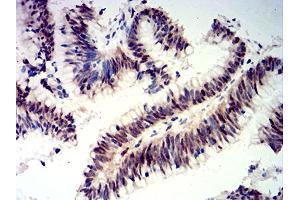 Immunohistochemical analysis of paraffin-embedded colon cancer tissues using CIRBP mouse mAb with DAB staining. (CIRBP Antikörper  (AA 1-90))