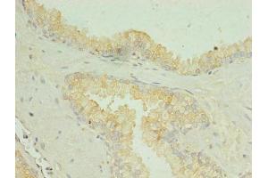 Immunohistochemistry of paraffin-embedded human prostate cancer using ABIN7169990 at dilution of 1:100 (SLC34A2 Antikörper  (AA 574-689))