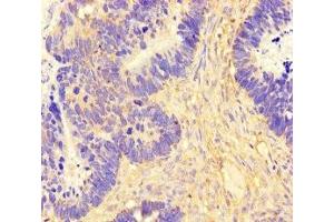 Immunohistochemistry of paraffin-embedded human ovarian cancer using ABIN7165554 at dilution of 1:100 (FAM71F2 Antikörper  (AA 1-300))