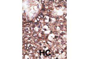 Formalin-fixed and paraffin-embedded human hepatocellular carcinoma tissue reacted with LRP8 polyclonal antibody  , which was peroxidase-conjugated to the secondary antibody, followed by DAB staining. (LRP8 Antikörper  (AA 934-963))
