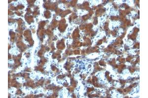 Formalin-fixed, paraffin-embedded human Hepatocellular Carcinoma stained with RBP1 Mouse Monoclonal Antibody (G4E4). (RBP4 Antikörper)