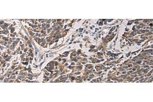 Immunohistochemistry of paraffin-embedded Human colorectal cancer tissue using MAPKAPK3 Polyclonal Antibody at dilution of 1:95(x200) (MAPKAP Kinase 3 Antikörper)