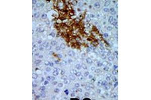 Formalin-fixed and paraffin-embedded human cancer tissue reacted with the primary antibody, which was peroxidase-conjugated to the secondary antibody, followed by AEC staining. (PNCK Antikörper  (C-Term))