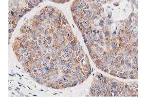 Immunohistochemical staining of paraffin-embedded Adenocarcinoma of Human breast tissue using anti-LCMT1 mouse monoclonal antibody. (LCMT1 Antikörper)