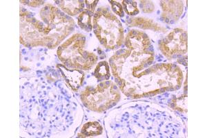 Paraformaldehyde-fixed, paraffin embedded Human breast carcinoma, Antigen retrieval by boiling in sodium citrate buffer (pH6) for 15min, Block endogenous peroxidase by 3% hydrogen peroxide for 30 minutes, Blocking buffer at 37°C for 20min, Antibody incubation with Cytokeratin 18 (1F11) Monoclonal Antibody  at 1:50 overnight at 4°C, followed by a conjugated secondary and DAB staining. (Cytokeratin 18 Antikörper)